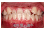 矯正治療前写真b1