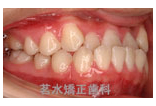 矯正治療前写真b2