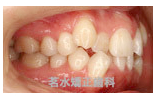 矯正治療前写真i2