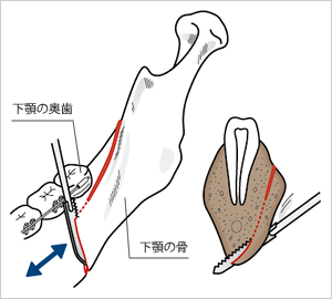 下顎の骨手術例