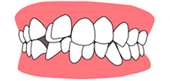 歯並び図